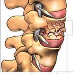 דוגמה לשבר דחיסה בחוליה אחת בעמוד השדרה.