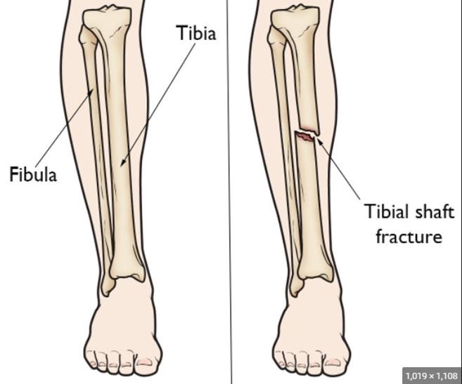 tibia