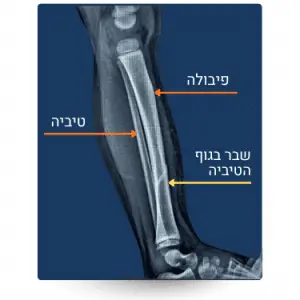 שבר בעצם הטיביה מתאונת דרכים